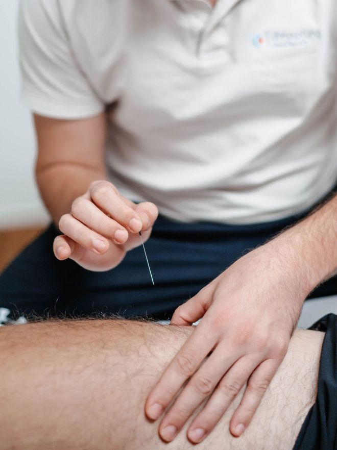 Nahaufnahme Dry Needling Akupunktur am Beim.